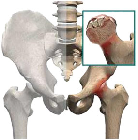 什么是股骨頭壞死